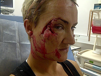 01Keala Kennelly found the reef in a brutal way while riding Teahupoo and the Billabong Pro