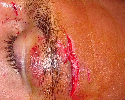 06This nasty looking wound was caused when the rider collided with her board It kind of looks like the Hollister logo Maybe a sponsorship deal is the silver lining to this particular cloud