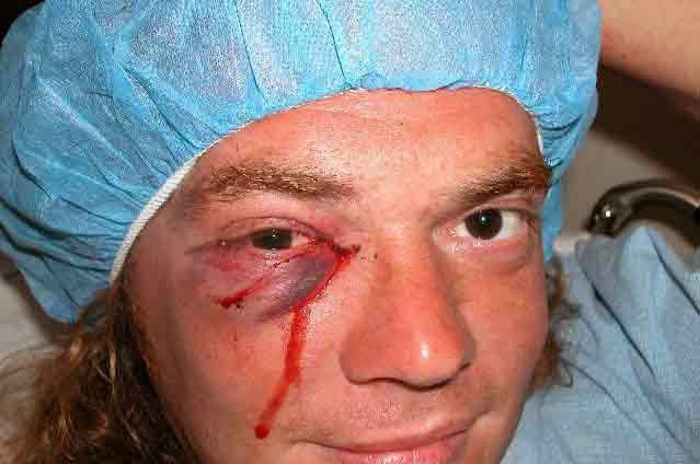 08Eight hours of surgery was required to save this dude's eye after he caught it with his fin