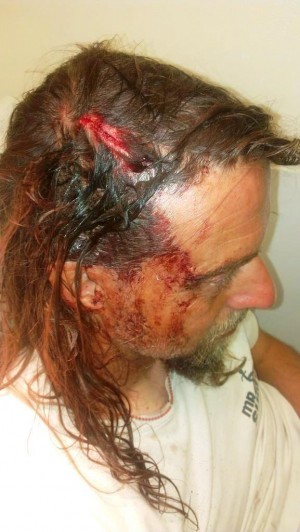 09Owner of the Mr Surfy cafe on Polzeath beach in Cornwall, Steve got scalped by some other guy's board “This guy just bailed jumping off his board sent it flying straight at me” said the Cornwall native