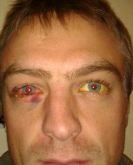 10A collision with his board while surfing near Swansea in Wales temporarily left this dude with those David Bowie-like different coloured eyes