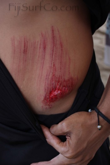 11As if the slashes from the reef aren’t bad enough, it also ripped away a good chunk of flesh
