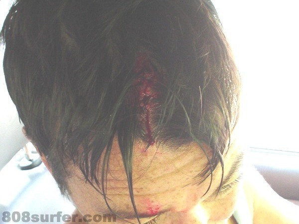 13It’s bad enough splitting your skull on the sea bed, but then the medics come along and use 12 staples to patch you back together
