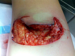 17What looks worryingly like a kebab-house pizza topping is actually a huge slash to a surfer's thigh. The rogue fin that created this gaping wound missed the femoral artery by just a couple of centimetres