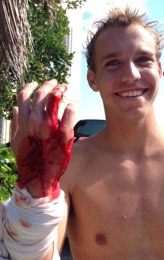 Cole Taschman, 16, shows his injuries after being bitten by a shark Sunday at Bathtub Beach in Jensen Beach.