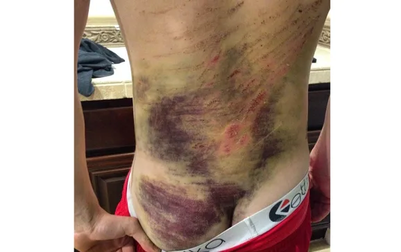 bruise 1