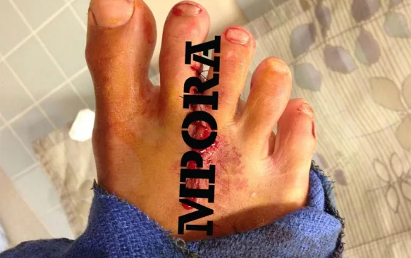 surfing injuries censored supracer com kai lenny foot gash sewn