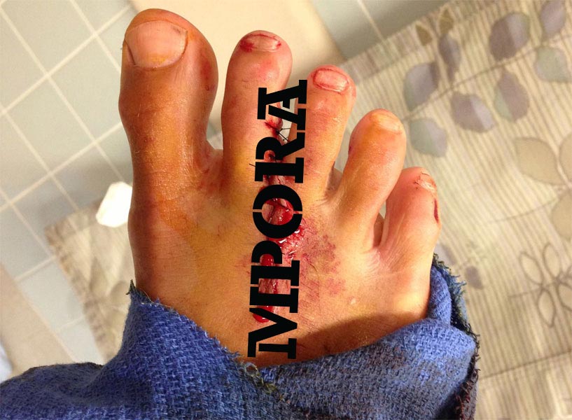surfing-injuries-censored-supracer-com-kai-lenny-foot-gash-sewn