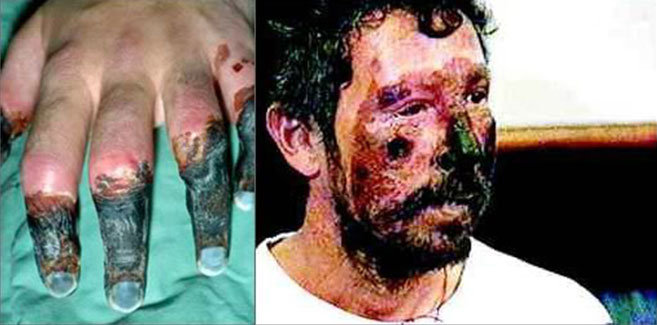 Beck Weathers suffered horrendous frostbite during the 1996 Mt Everest disaster, yet lived to tell the tale. Photo: adventure-journal.com